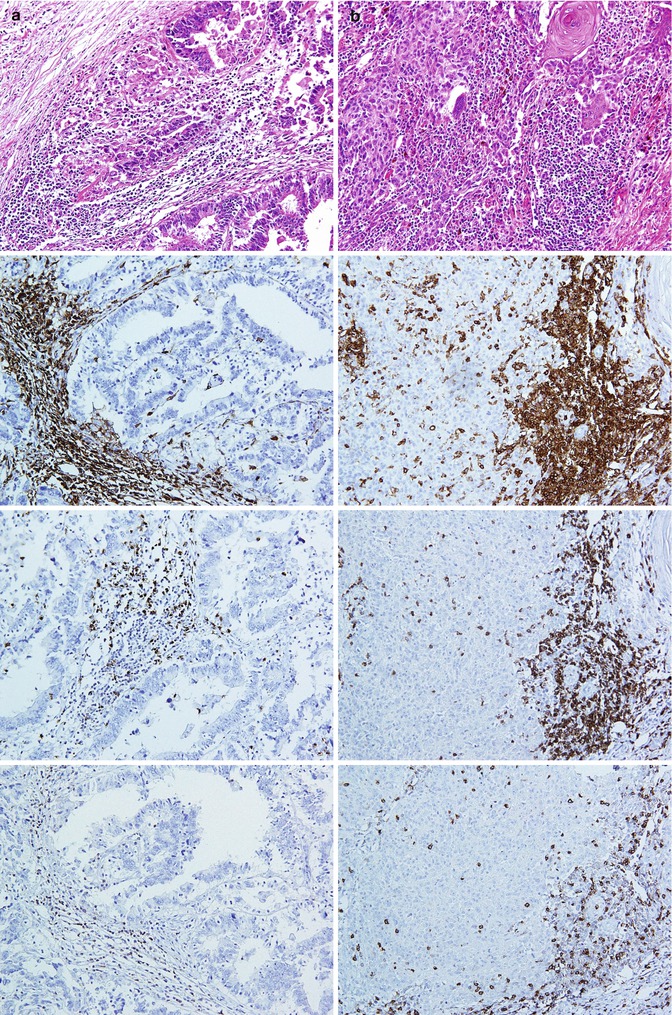 Immunohistochemistry Of Cancers | Oncohema Key