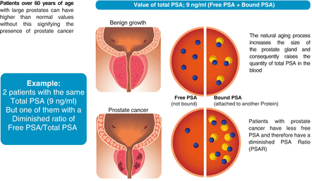 Despre PSA seric - antigenul prostatic specific - UROCLINIC - Clinica de Urologie Craiova