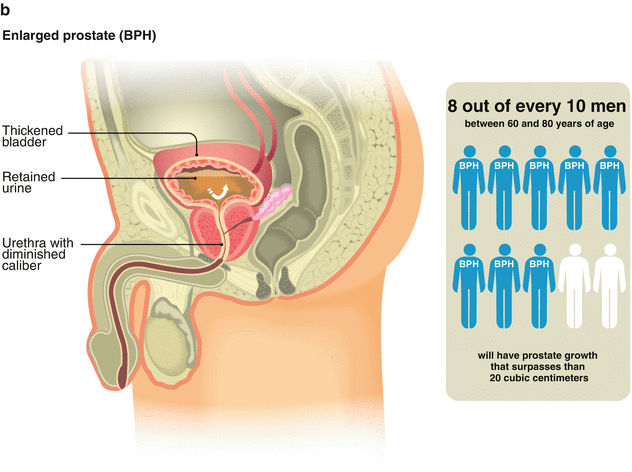 how to reduce prostate enlargement naturally