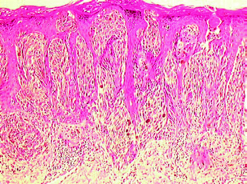 spindle cell melanoma
