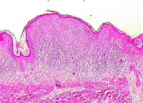 melanocytic nevus tumors pathology skin fig