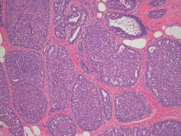 sclerosing papilloma with atypical ductal hyperplasia cervicită cu condilom plat