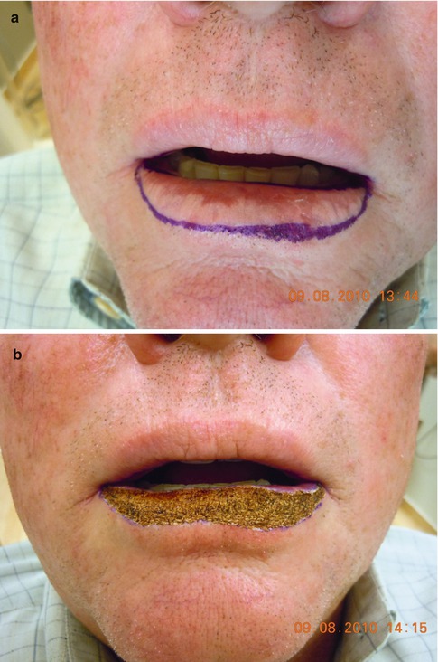 Pictures Of Lip Cancer After Surgery