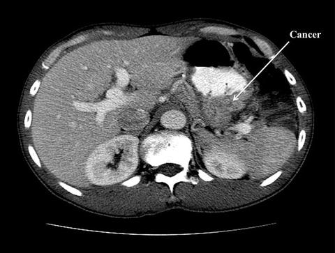 gastric cancer ct)