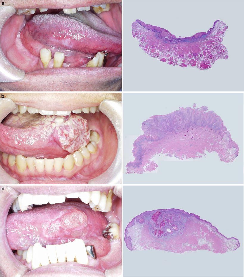 Surgical Pathology of Oral Cancer | Oncohema Key