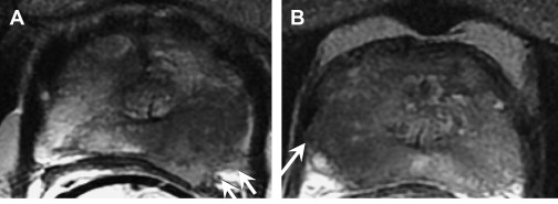 Imaging In Prostate Carcinoma Oncohema Key