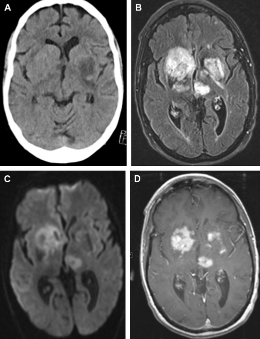 Neuroimaging in Central Nervous System Lymphoma | Oncohema Key