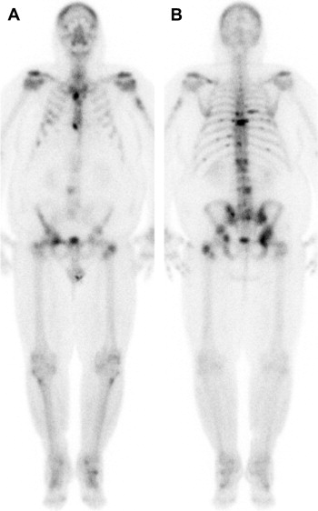 Imaging In Prostate Carcinoma Oncohema Key