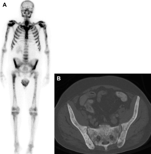 Imaging In Prostate Carcinoma Oncohema Key