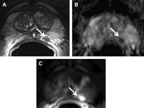 Imaging In Prostate Carcinoma Oncohema Key