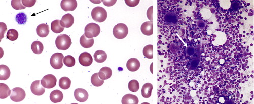 idiopathic thrombocytopenic purpura smear