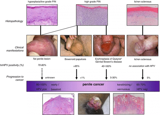 Benign (Not Cancerous) Urethral Lesions: Symptoms, Diagnosis