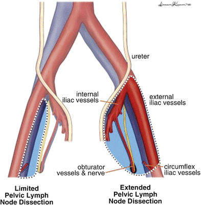 Pelvic Lymph Node Dissection for Penile Cancer: Answering the Conundrum ...