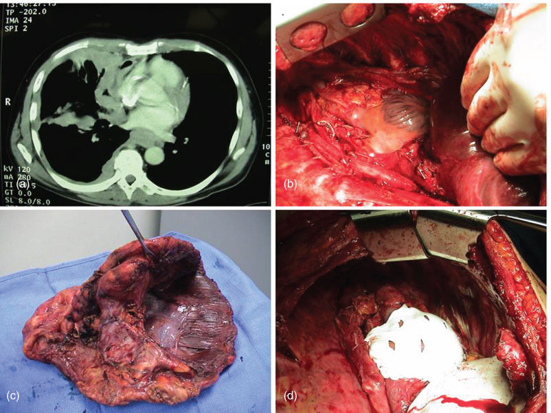 Malignant pleural mesothelioma | Oncohema Key