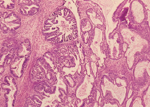 Epithelial ovarian, fallopian tube, and peritoneal cancer | Oncohema Key