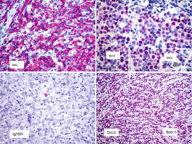 Primary Mediastinal Large B-Cell Lymphoma | Oncohema Key