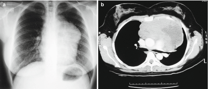 Primary Mediastinal Large B-Cell Lymphoma | Oncohema Key