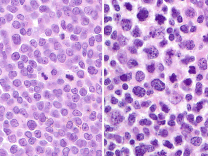 Mantle Cell Lymphoma | Oncohema Key