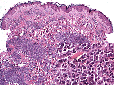 Primary Cutaneous B-Cell Lymphomas | Oncohema Key