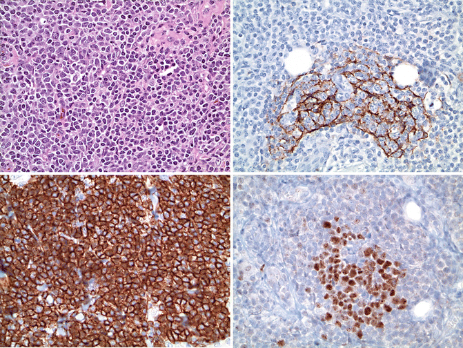 Primary Cutaneous B-Cell Lymphomas | Oncohema Key