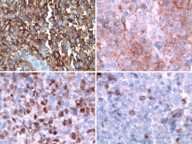 Primary Cutaneous B-Cell Lymphomas | Oncohema Key