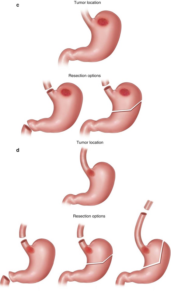 Standards For Surgical Therapy Of Gastric Cancer | Oncohema Key