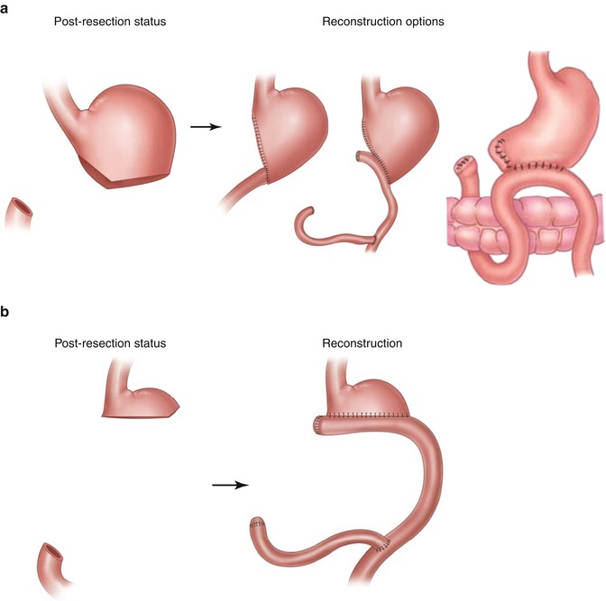 Standards For Surgical Therapy Of Gastric Cancer | Oncohema Key