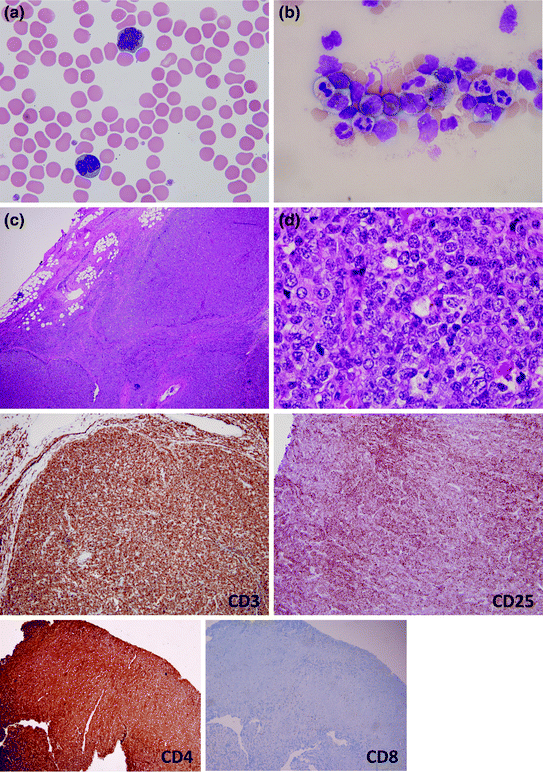 Of T-Cell Lymphomas: Diagnosis And Biomarker Discovery | Oncohema Key