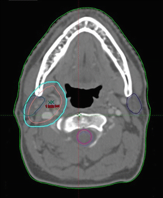 Diffuse Large B-Cell Lymphoma | Oncohema Key