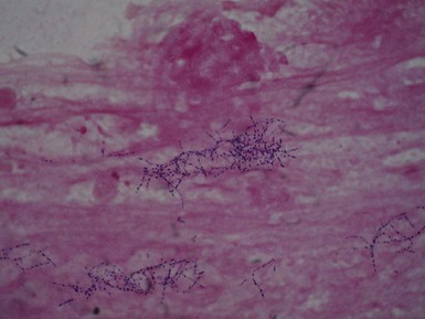 Nocardia Species | Oncohema Key