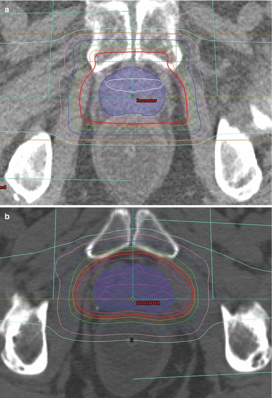 Proton Therapy For The Treatment Of Prostate Cancer | Oncohema Key