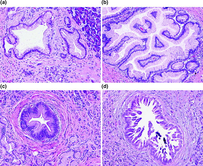 Pathology And Molecular Pathology Of Pancreatic Cancer | Oncohema Key