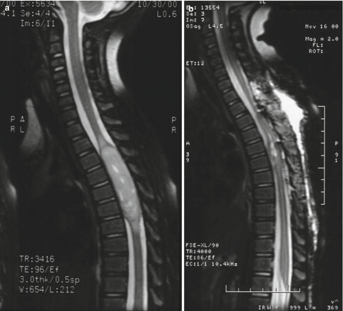 Intramedullary Spinal Cord Tumors | Oncohema Key