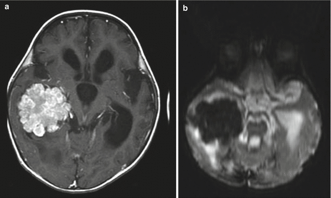 Choroid Plexus Tumors | Oncohema Key