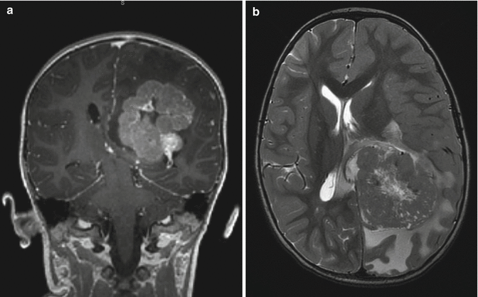 Choroid Plexus Tumors | Oncohema Key