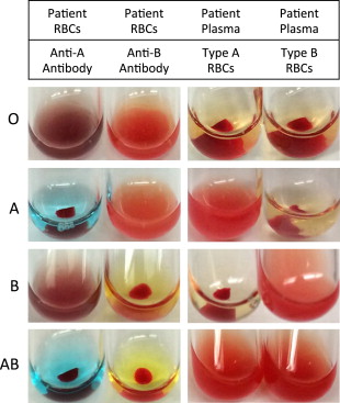 Hemolysis From ABO Incompatibility | Oncohema Key