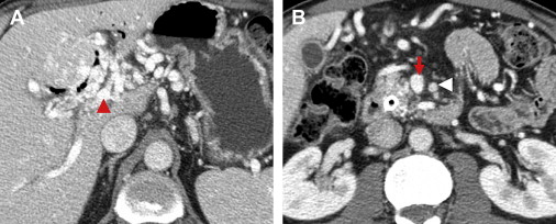 Management Of Borderline Resectable Pancreatic Cancer | Oncohema Key