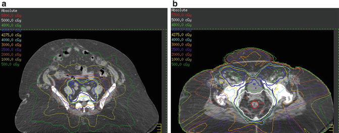 Radiation Therapy For Rectal Cancer | Oncohema Key