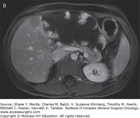 Benign Liver Tumors | Oncohema Key