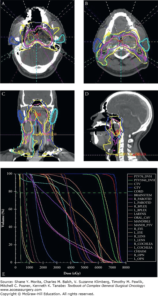 Nasopharyngeal Cancer | Oncohema Key