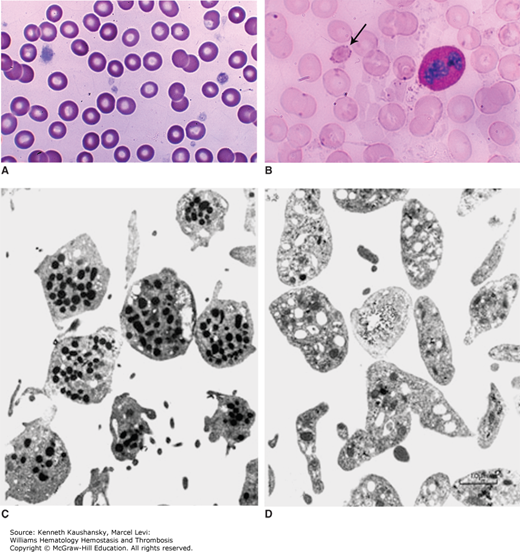 Hereditary Qualitative Platelet Disorders | Oncohema Key