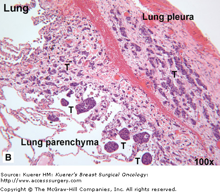 Metastasis | Oncohema Key