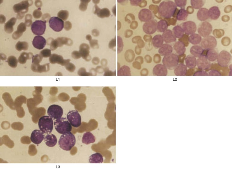 Acute Lymphoblastic Leukemia Oncohema Key