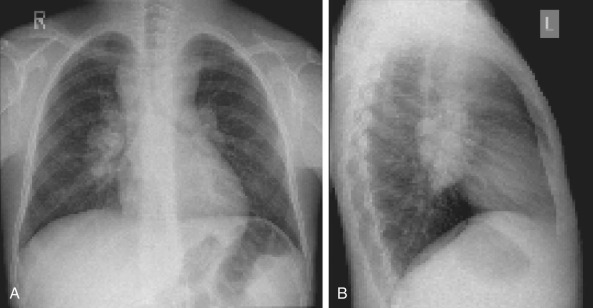 Pediatric Lymphoma | Oncohema Key