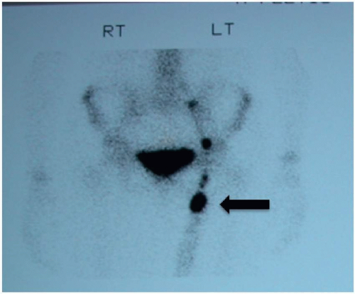 Sentinel Lymph Node Biopsy | Oncohema Key