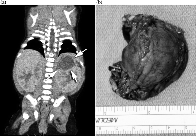 The Evaluation And Management Of Adrenal Masses And Adrenocortical ...