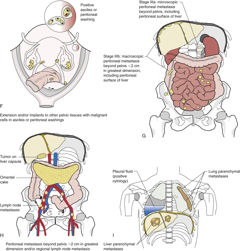 Epithelial Ovarian Cancer | Oncohema Key