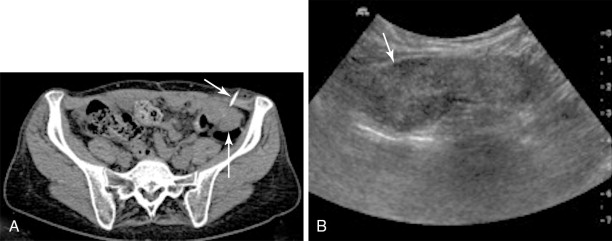 Interventional Strategies In The Treatment Of Gynecologic Cancers ...