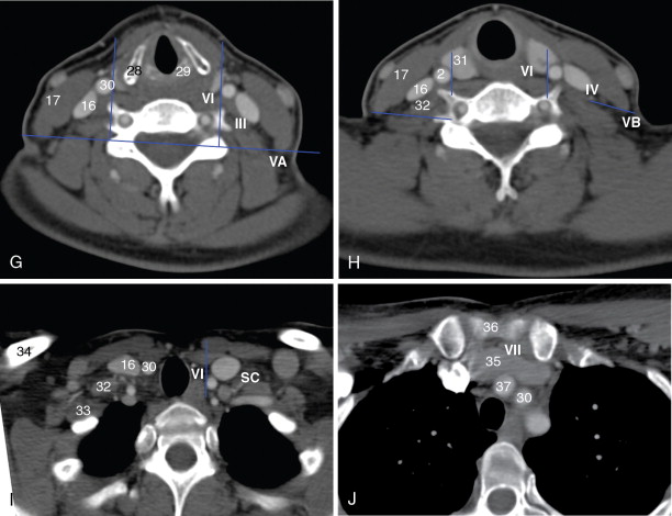 Imaging Of Head And Neck Cancer | Oncohema Key