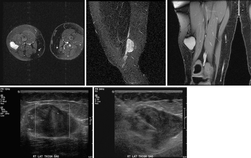 Percutaneous Musculoskeletal Biopsy | Oncohema Key